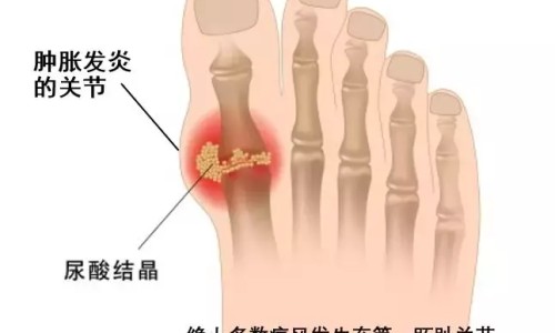 肝硬化病人常见症状不包括-权威肝硬化的征象平台,分享专业肝硬化的知识_肝硬化病人常见症状网